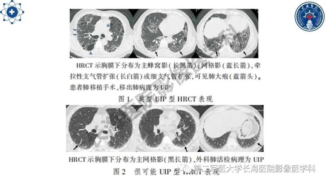 影像PPT - 【PPT】特发性肺纤维化的影像表现-21