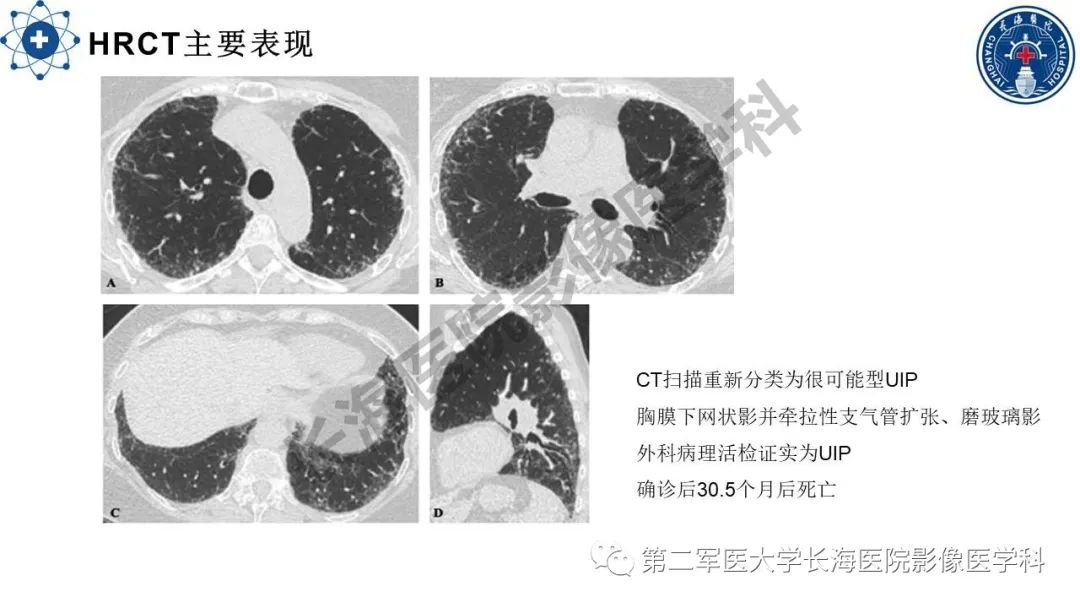 影像PPT - 【PPT】特发性肺纤维化的影像表现-22
