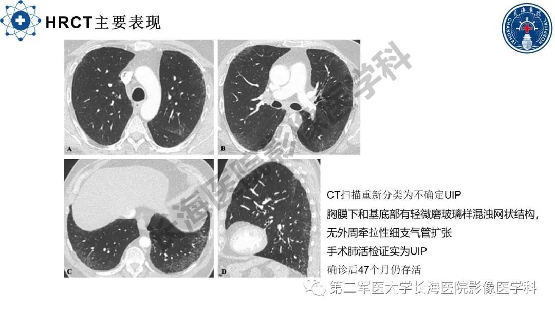 影像PPT - 【PPT】特发性肺纤维化的影像表现-23