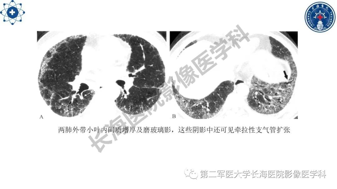 影像PPT - 【PPT】特发性肺纤维化的影像表现-24