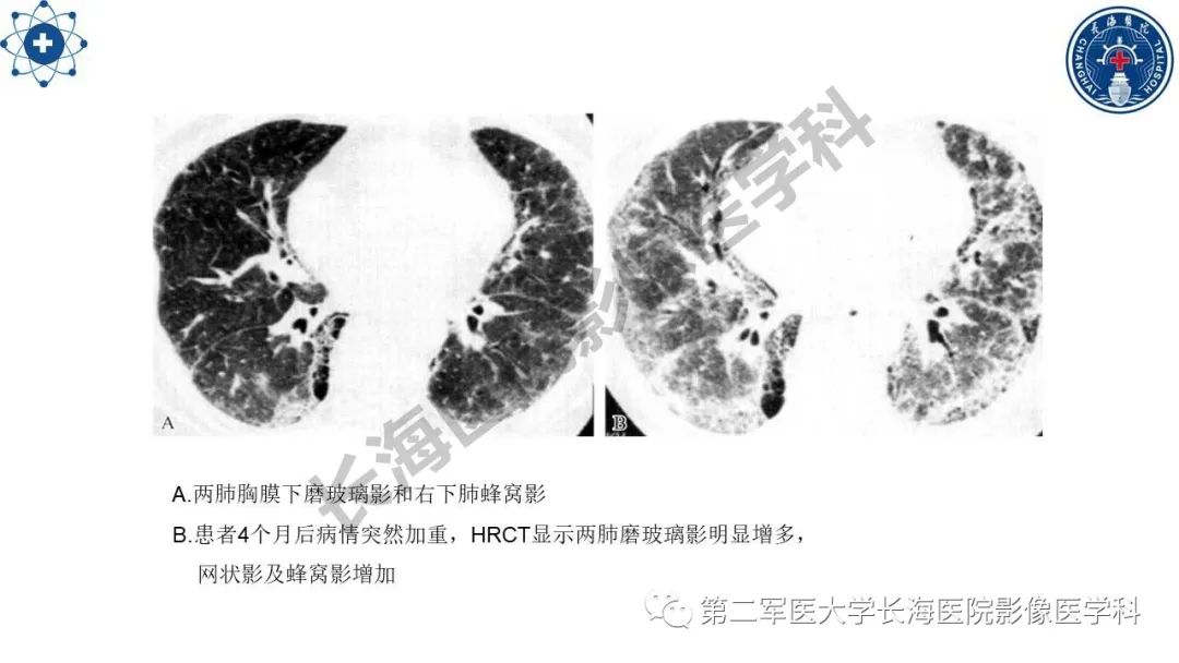 影像PPT - 【PPT】特发性肺纤维化的影像表现-27