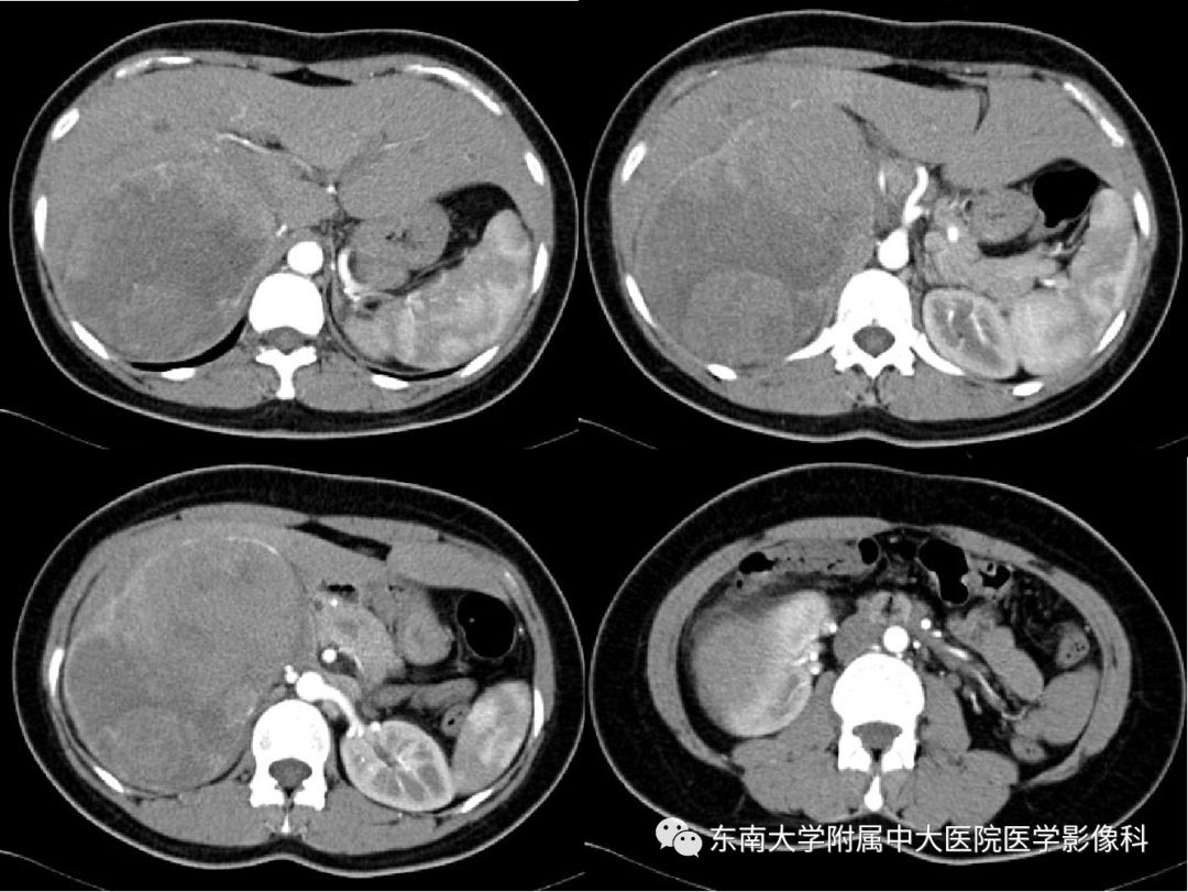 影像PPT - 【病例】肾上腺嗜铬细胞瘤1例CT影像诊断与鉴别诊断-2