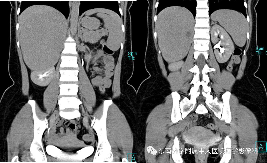影像PPT - 【病例】肾上腺嗜铬细胞瘤1例CT影像诊断与鉴别诊断-5