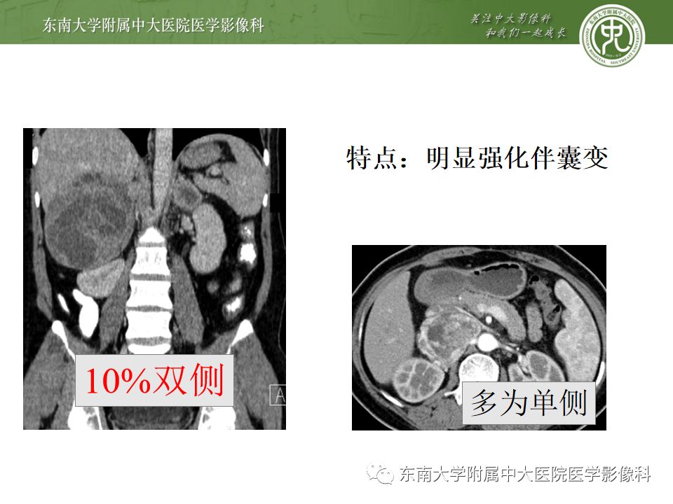 影像PPT - 【病例】肾上腺嗜铬细胞瘤1例CT影像诊断与鉴别诊断-12