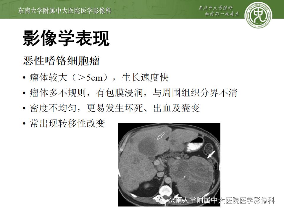 影像PPT - 【病例】肾上腺嗜铬细胞瘤1例CT影像诊断与鉴别诊断-13