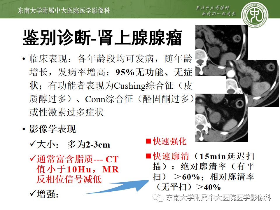 影像PPT - 【病例】肾上腺嗜铬细胞瘤1例CT影像诊断与鉴别诊断-14