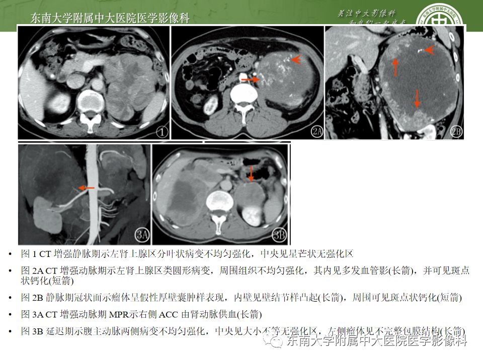 影像PPT - 【病例】肾上腺嗜铬细胞瘤1例CT影像诊断与鉴别诊断-17