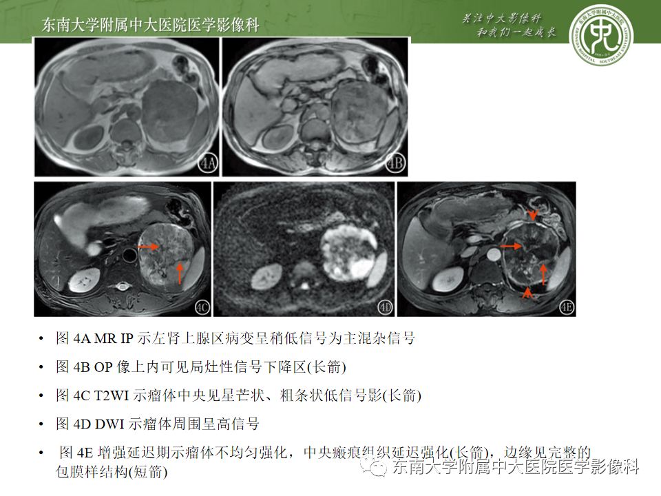 影像PPT - 【病例】肾上腺嗜铬细胞瘤1例CT影像诊断与鉴别诊断-18