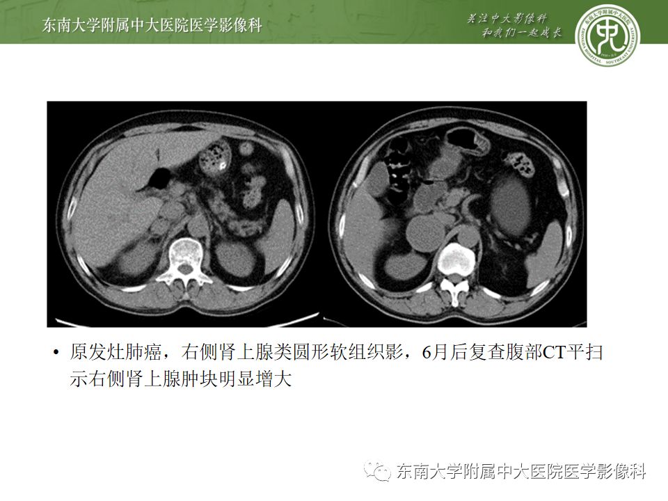 影像PPT - 【病例】肾上腺嗜铬细胞瘤1例CT影像诊断与鉴别诊断-20