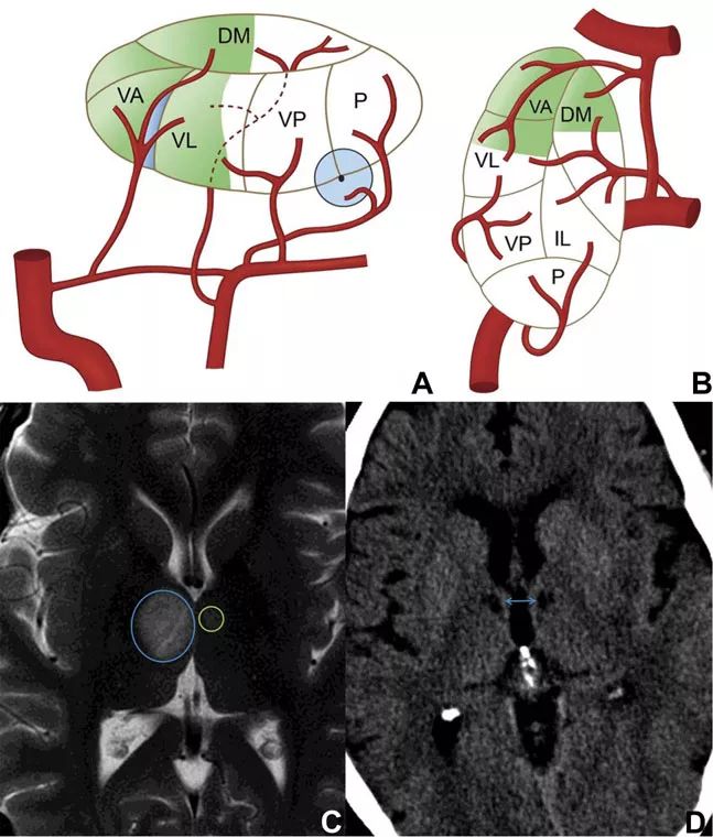 影像PPT - 丘脑梗死临床症状及其相关机制-4 影像PPT - 丘脑梗死临床症状及其相关机制-4