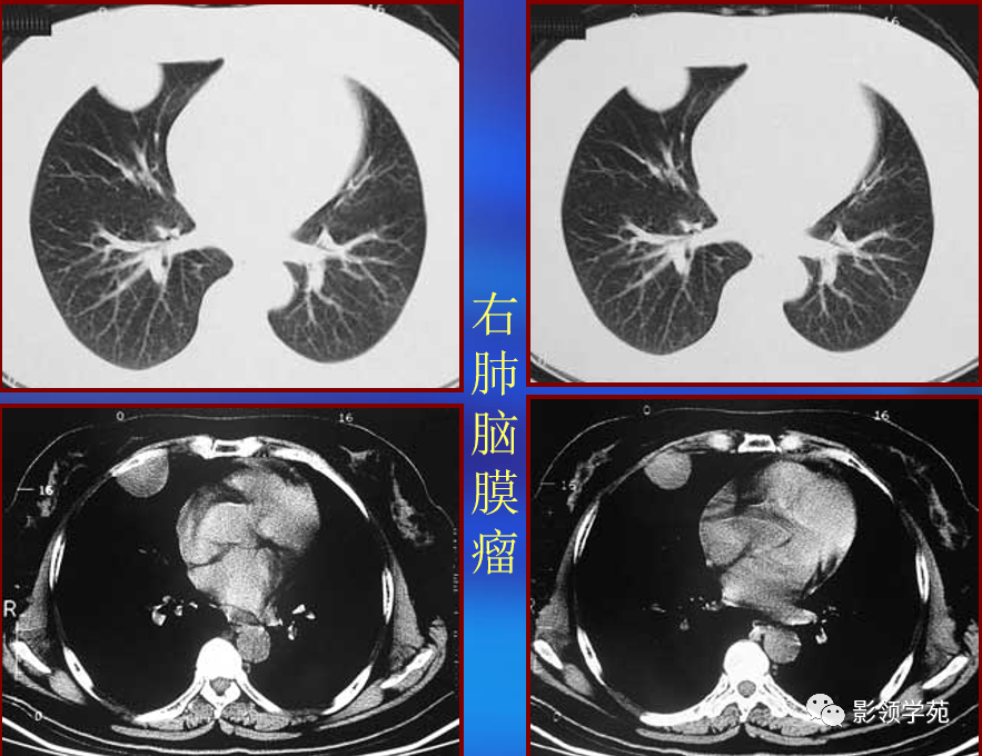 影像PPT - 肺良性肿瘤影像表现-19 影像PPT - 肺良性肿瘤影像表现-19