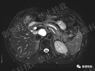 影像PPT - 【病例】胰腺导管内乳头状黏液肿瘤1例MR影像-2 影像PPT - 【病例】胰腺导管内乳头状黏液肿瘤1例MR影像-2