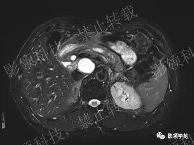 影像PPT - 【病例】胰腺导管内乳头状黏液肿瘤1例MR影像-3 影像PPT - 【病例】胰腺导管内乳头状黏液肿瘤1例MR影像-3
