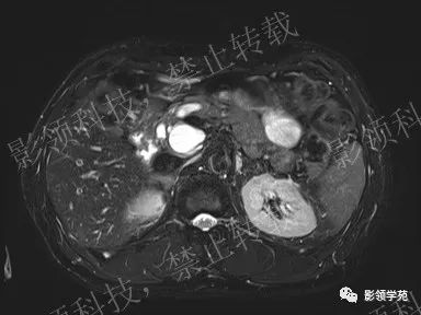 影像PPT - 【病例】胰腺导管内乳头状黏液肿瘤1例MR影像-4 影像PPT - 【病例】胰腺导管内乳头状黏液肿瘤1例MR影像-4