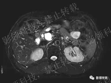 影像PPT - 【病例】胰腺导管内乳头状黏液肿瘤1例MR影像-5 影像PPT - 【病例】胰腺导管内乳头状黏液肿瘤1例MR影像-5