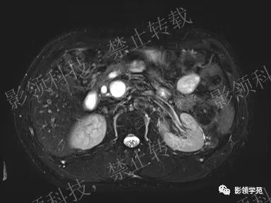 影像PPT - 【病例】胰腺导管内乳头状黏液肿瘤1例MR影像-6 影像PPT - 【病例】胰腺导管内乳头状黏液肿瘤1例MR影像-6