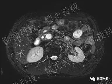 影像PPT - 【病例】胰腺导管内乳头状黏液肿瘤1例MR影像-7 影像PPT - 【病例】胰腺导管内乳头状黏液肿瘤1例MR影像-7