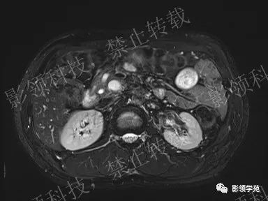 影像PPT - 【病例】胰腺导管内乳头状黏液肿瘤1例MR影像-8 影像PPT - 【病例】胰腺导管内乳头状黏液肿瘤1例MR影像-8