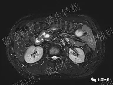 影像PPT - 【病例】胰腺导管内乳头状黏液肿瘤1例MR影像-9 影像PPT - 【病例】胰腺导管内乳头状黏液肿瘤1例MR影像-9