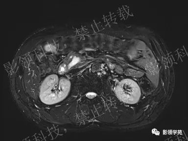 影像PPT - 【病例】胰腺导管内乳头状黏液肿瘤1例MR影像-10 影像PPT - 【病例】胰腺导管内乳头状黏液肿瘤1例MR影像-10