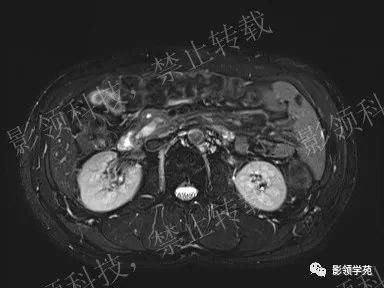 影像PPT - 【病例】胰腺导管内乳头状黏液肿瘤1例MR影像-11 影像PPT - 【病例】胰腺导管内乳头状黏液肿瘤1例MR影像-11