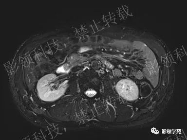 影像PPT - 【病例】胰腺导管内乳头状黏液肿瘤1例MR影像-12 影像PPT - 【病例】胰腺导管内乳头状黏液肿瘤1例MR影像-12