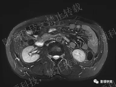 影像PPT - 【病例】胰腺导管内乳头状黏液肿瘤1例MR影像-13 影像PPT - 【病例】胰腺导管内乳头状黏液肿瘤1例MR影像-13