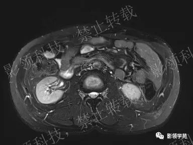 影像PPT - 【病例】胰腺导管内乳头状黏液肿瘤1例MR影像-14 影像PPT - 【病例】胰腺导管内乳头状黏液肿瘤1例MR影像-14