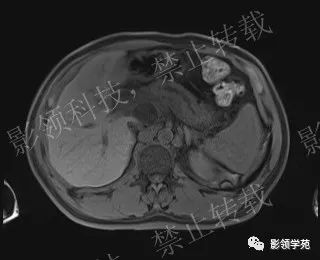 影像PPT - 【病例】胰腺导管内乳头状黏液肿瘤1例MR影像-15 影像PPT - 【病例】胰腺导管内乳头状黏液肿瘤1例MR影像-15