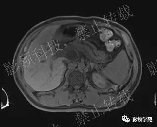 影像PPT - 【病例】胰腺导管内乳头状黏液肿瘤1例MR影像-16 影像PPT - 【病例】胰腺导管内乳头状黏液肿瘤1例MR影像-16