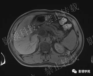 影像PPT - 【病例】胰腺导管内乳头状黏液肿瘤1例MR影像-17 影像PPT - 【病例】胰腺导管内乳头状黏液肿瘤1例MR影像-17
