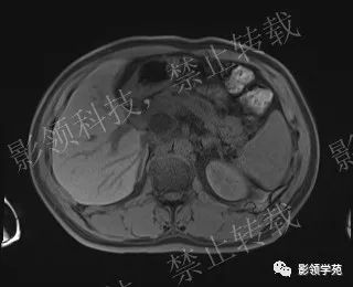 影像PPT - 【病例】胰腺导管内乳头状黏液肿瘤1例MR影像-18 影像PPT - 【病例】胰腺导管内乳头状黏液肿瘤1例MR影像-18