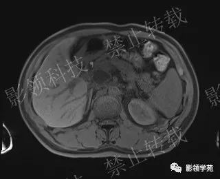 影像PPT - 【病例】胰腺导管内乳头状黏液肿瘤1例MR影像-19 影像PPT - 【病例】胰腺导管内乳头状黏液肿瘤1例MR影像-19