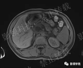 影像PPT - 【病例】胰腺导管内乳头状黏液肿瘤1例MR影像-20 影像PPT - 【病例】胰腺导管内乳头状黏液肿瘤1例MR影像-20