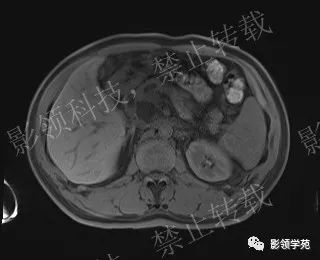 影像PPT - 【病例】胰腺导管内乳头状黏液肿瘤1例MR影像-21 影像PPT - 【病例】胰腺导管内乳头状黏液肿瘤1例MR影像-21