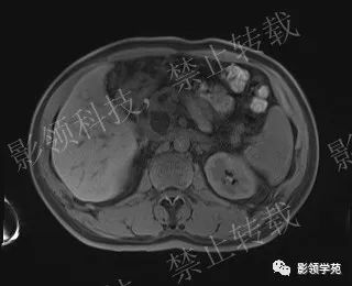影像PPT - 【病例】胰腺导管内乳头状黏液肿瘤1例MR影像-22 影像PPT - 【病例】胰腺导管内乳头状黏液肿瘤1例MR影像-22