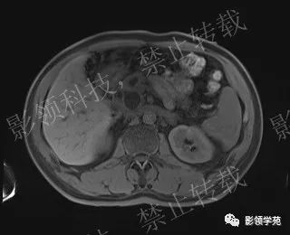 影像PPT - 【病例】胰腺导管内乳头状黏液肿瘤1例MR影像-23 影像PPT - 【病例】胰腺导管内乳头状黏液肿瘤1例MR影像-23