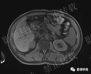 影像PPT - 【病例】胰腺导管内乳头状黏液肿瘤1例MR影像-24 影像PPT - 【病例】胰腺导管内乳头状黏液肿瘤1例MR影像-24