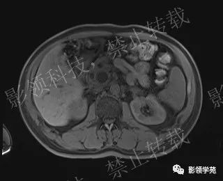 影像PPT - 【病例】胰腺导管内乳头状黏液肿瘤1例MR影像-25 影像PPT - 【病例】胰腺导管内乳头状黏液肿瘤1例MR影像-25