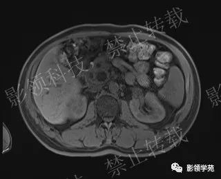 影像PPT - 【病例】胰腺导管内乳头状黏液肿瘤1例MR影像-26 影像PPT - 【病例】胰腺导管内乳头状黏液肿瘤1例MR影像-26