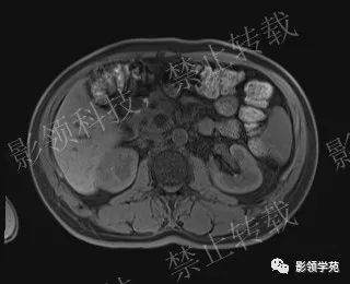 影像PPT - 【病例】胰腺导管内乳头状黏液肿瘤1例MR影像-28 影像PPT - 【病例】胰腺导管内乳头状黏液肿瘤1例MR影像-28