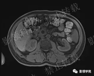 影像PPT - 【病例】胰腺导管内乳头状黏液肿瘤1例MR影像-29 影像PPT - 【病例】胰腺导管内乳头状黏液肿瘤1例MR影像-29