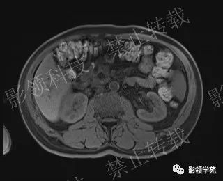 影像PPT - 【病例】胰腺导管内乳头状黏液肿瘤1例MR影像-30 影像PPT - 【病例】胰腺导管内乳头状黏液肿瘤1例MR影像-30