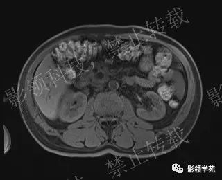 影像PPT - 【病例】胰腺导管内乳头状黏液肿瘤1例MR影像-31 影像PPT - 【病例】胰腺导管内乳头状黏液肿瘤1例MR影像-31
