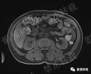 影像PPT - 【病例】胰腺导管内乳头状黏液肿瘤1例MR影像-32 影像PPT - 【病例】胰腺导管内乳头状黏液肿瘤1例MR影像-32