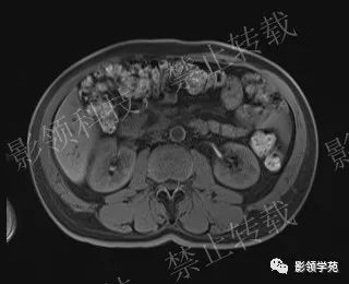 影像PPT - 【病例】胰腺导管内乳头状黏液肿瘤1例MR影像-33 影像PPT - 【病例】胰腺导管内乳头状黏液肿瘤1例MR影像-33