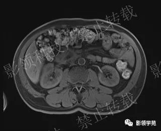 影像PPT - 【病例】胰腺导管内乳头状黏液肿瘤1例MR影像-34 影像PPT - 【病例】胰腺导管内乳头状黏液肿瘤1例MR影像-34