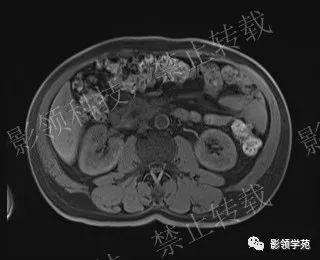 影像PPT - 【病例】胰腺导管内乳头状黏液肿瘤1例MR影像-35 影像PPT - 【病例】胰腺导管内乳头状黏液肿瘤1例MR影像-35