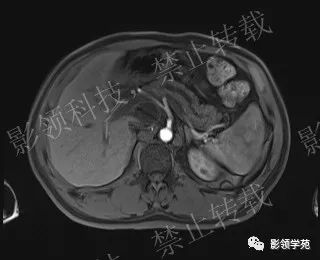 影像PPT - 【病例】胰腺导管内乳头状黏液肿瘤1例MR影像-36 影像PPT - 【病例】胰腺导管内乳头状黏液肿瘤1例MR影像-36