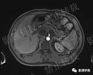 影像PPT - 【病例】胰腺导管内乳头状黏液肿瘤1例MR影像-37 影像PPT - 【病例】胰腺导管内乳头状黏液肿瘤1例MR影像-37